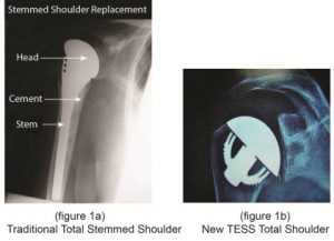 Minimally Invasive Total Shoulder Replacement-New TESS Total Shoulder performed by Dr. Bartholomew.