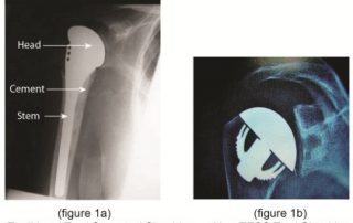 TESS Total Shoulder