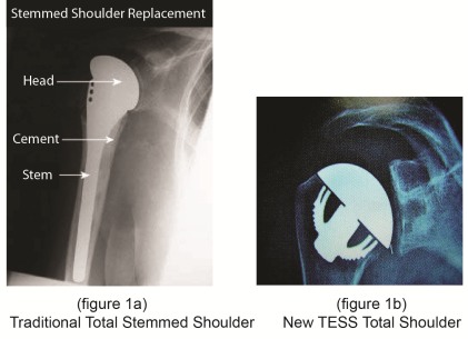 TESS Total Shoulder