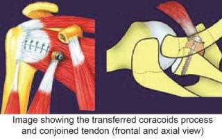 Arthroscopic Bristow-Latarjet