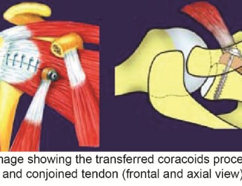 Arthroscopic Latarjet Procedure for Shoulder Instability