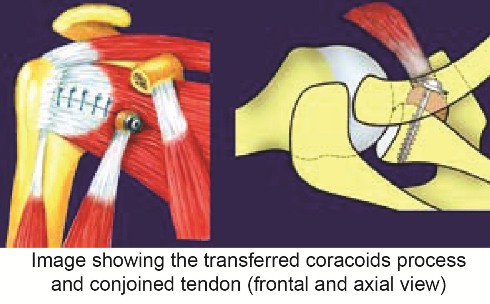 Arthroscopic Bristow-Latarjet