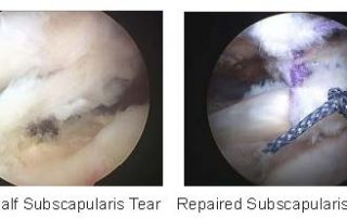 Subscapularis Tendon Tear Repair
