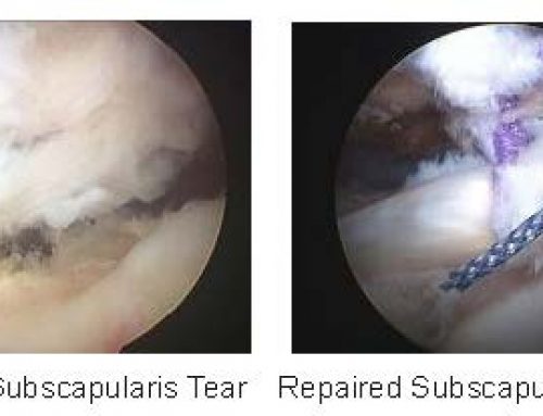 Arthroscopic Subscapularis Tendon Tear Repair