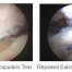 Subscapularis Tendon Tear Repair