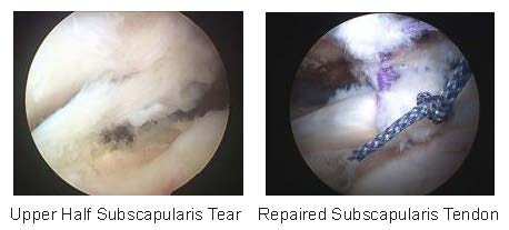 Subscapularis Tendon Tear Repair