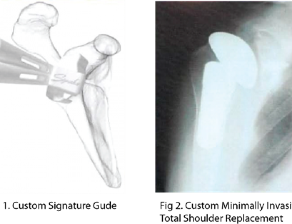 Minimally Invasive Shoulder Replacement TESS Shoulder Arthroplasty