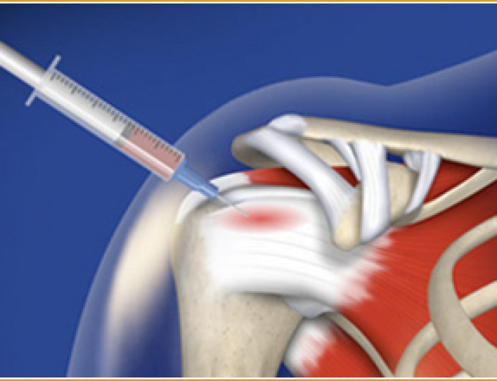 Shoulder Impingement Syndrome Pinched Nerve in Shoulder