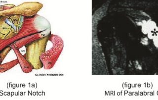 Suprascapular Nerve Entrapment-Paralabral Cyst