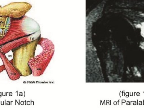 Suprascapular Nerve Entrapment