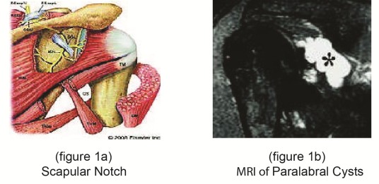 Suprascapular Nerve Entrapment, Paralabral Cyst photo