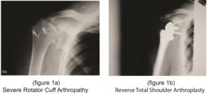 New option for Shoulder Replacement- Reverse Total Shoulder Arthroplasty