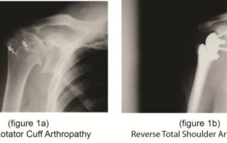 Reverse Total Shoulder Arthroplasty