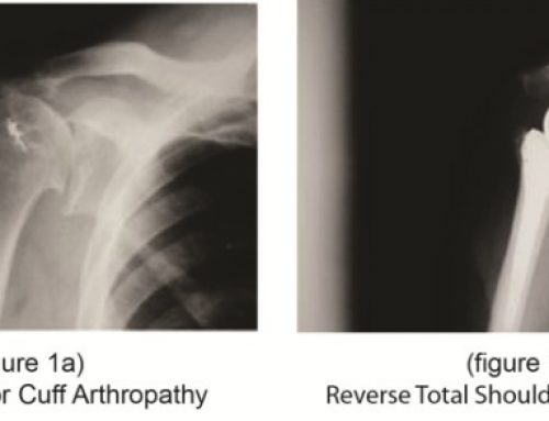 New Option for Shoulder Replacement