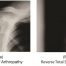 Reverse Total Shoulder Arthroplasty