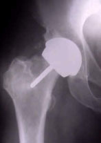 Birmingham Hip Resurfacing (BHR) | Hip Arthroplasty