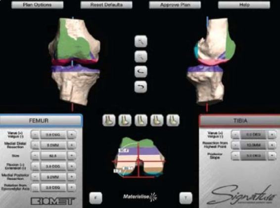 Minimally Invasive Signature Custom Fit Knee Replacement