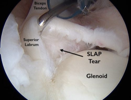 Arthroscopic SLAP Repair