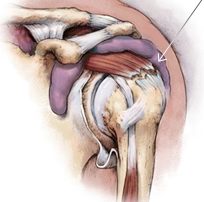 Torn Rotator cuff, Dr. Bartholomew, Shoulder surgeon