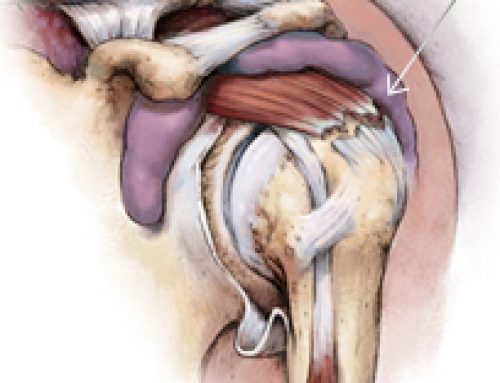 Arthroscopic Rotator Cuff Repair