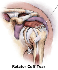 Torn Rotator cuff