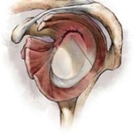 Bone and Joint Specialists-SLAP Repair | Torn Shoulder Labrum