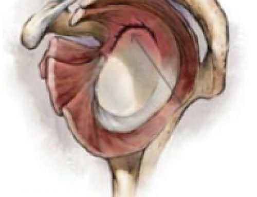 SLAP Tear | Labral Tear