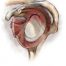 Bone and Joint Specialists-SLAP Repair | Torn Shoulder Labrum
