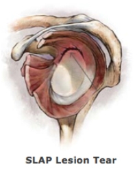Bone and Joint Specialists-shoulder slap tear SLAP Repair | Torn Shoulder Labrum | Dr. Bartholomew-Shoulder Expert-SLAP Lesion Repair or SLAP Repair is an arthroscopic shoulder procedure to treat a torn labrum. The injury occurs from repeated use of the shoulder.