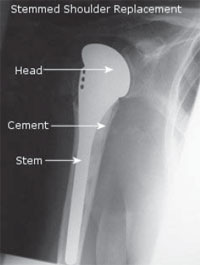 Total Shoulder Replacement, Total Shoulder Arthroplasty