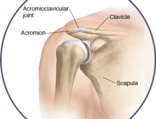 Acromioclavicular- AC Joint Separation | Separated Shoulder
