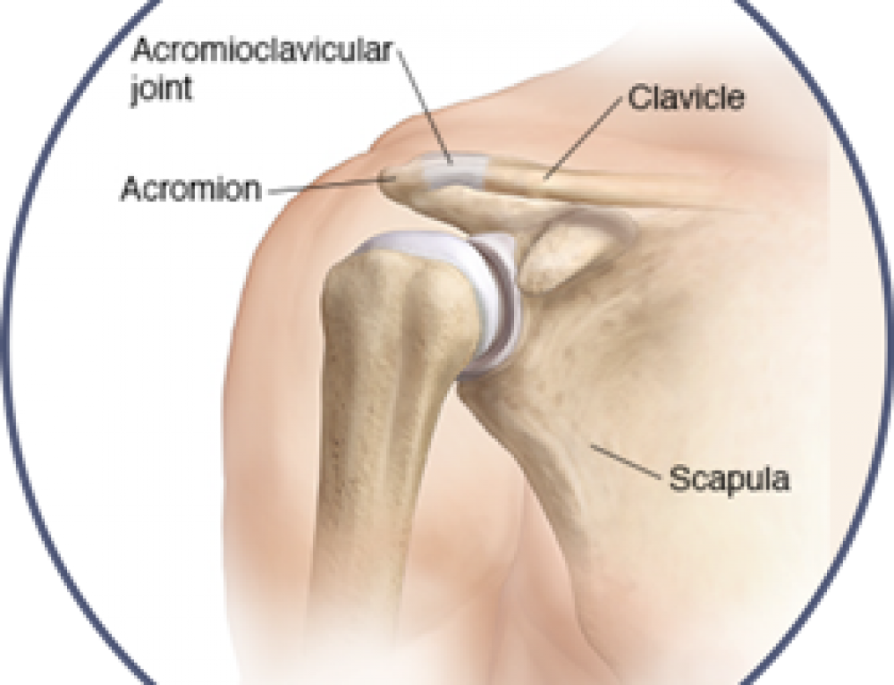 Shoulder Impingement Syndrome Pinched Nerve in Shoulder