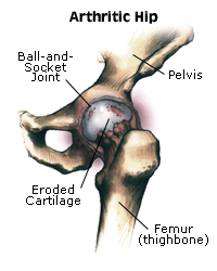 Bone and Joint Specialists, Arthritis in Hip Photo