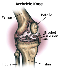 Bone and Joint Specialists, Arthritis in Knee Photo