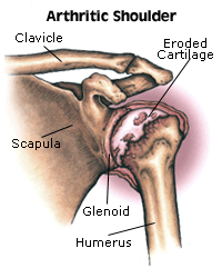 Bone and Joint Specialists, Arthritis in Shoulder Photo