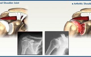 Bone and Joint Specialists- arthritis in shoulder photo