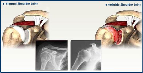 Shoulder Pain, Arthritis, Torn Rotator Cuff