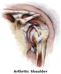 Arthritis in Shoulder- Bone and Joint Specialists