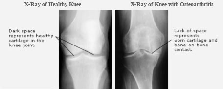 Diagnosing Arthritis-Photo of Arthritis x-ray