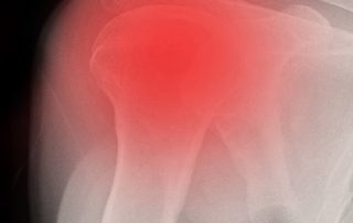 Bone and Joint Specialists- frozen shoulder photo