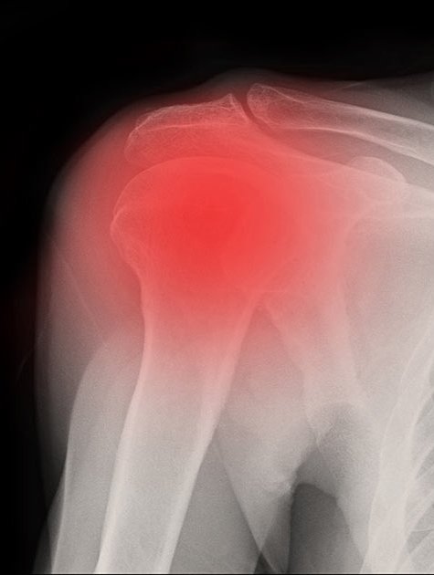 Bone and Joint Specialists- frozen shoulder photo