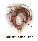 Bankart Lesion Tear Injury