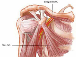 shoulder impingement syndrome photo.