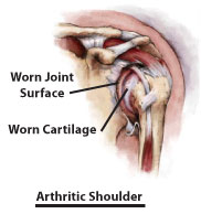 Arthritis in Shoulder- Bone and Joint Specialists