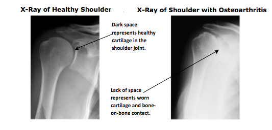 Causes of Shoulder pain-Shoulder arthritis x-ray photo