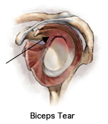 Shoulder Biceps Tendon Tear