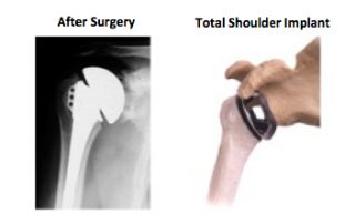 Total Shoulder Replacement Implant