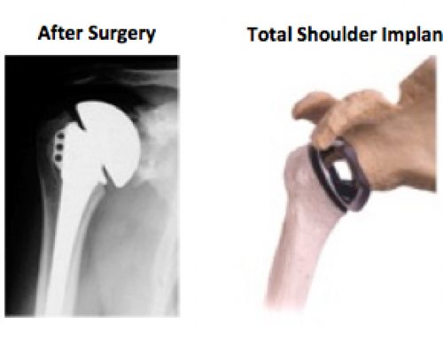 Total Shoulder Replacement