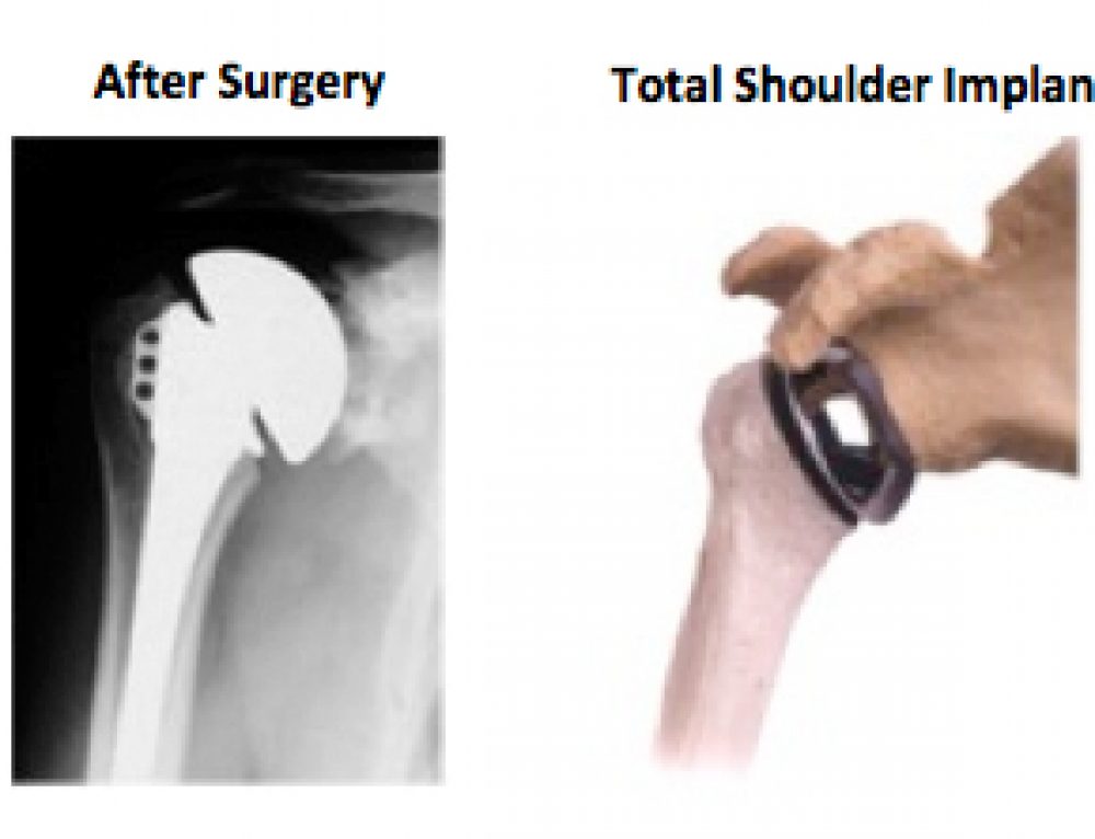 Minimally Invasive Shoulder Replacement TESS Shoulder Arthroplasty