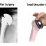 Total Shoulder Replacement Implant